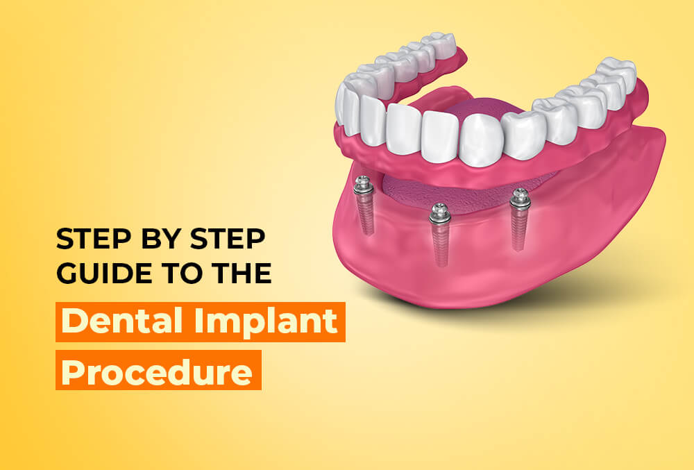step by step guide to the dental implant procedure