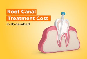 root canal treatment cost in hyderabad