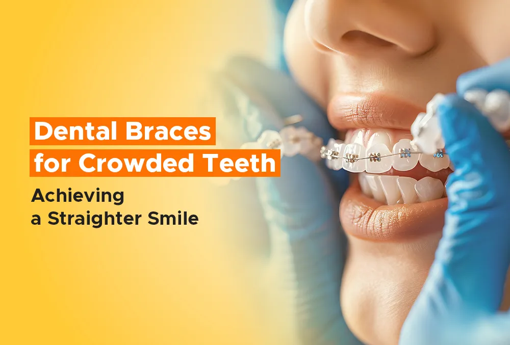 Dental Braces for Crowded Teeth: Achieving a Straighter Smile