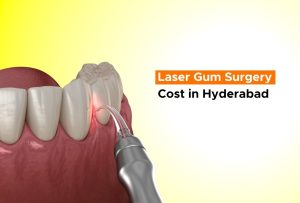 laser gum surgery cost in hyderabad