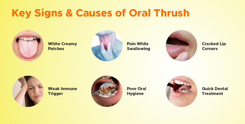 common oral thrush