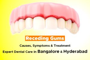 receding gums causes , symptoms & treatment expert dental care in bangalore & hyderabad