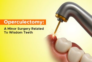 operculectomy