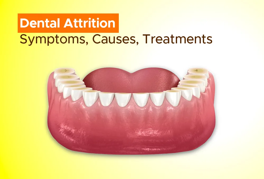 Dental Attrition: Symptoms, Causes, Treatments