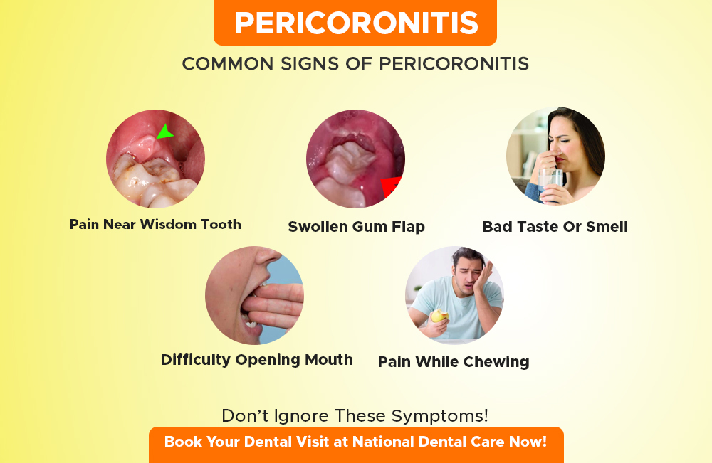 common-signs-of-pericoronitis---info