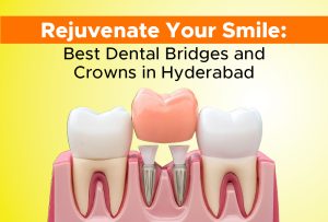 ndc-best-dental-bridges