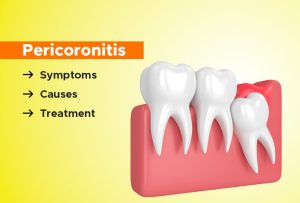 Pericoronitis
