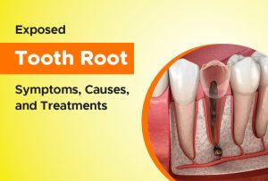 exposed-tooth-root-symptoms-causes,-and-treatments