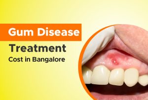 gum-disease-treatment-cost-in-bangalore