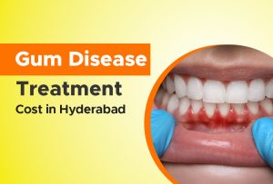 gum-disease-treatment-cost-in-hyderabad