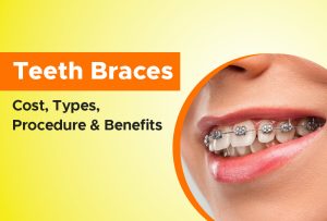 teeth braces cost types procedure benefits